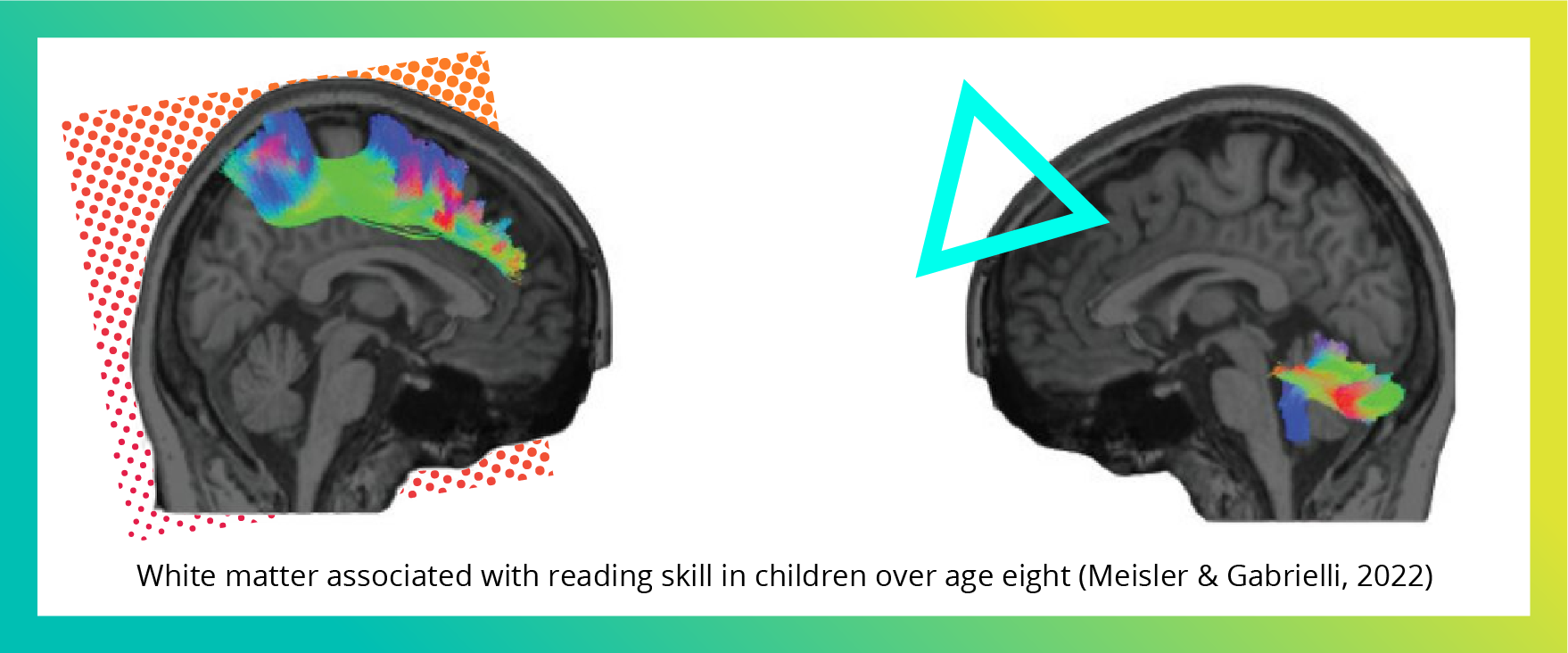 White matter in brain scans